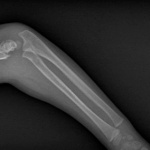 Broken Bones Motorcycle Accident Lawyers Serving Fort Lauderdale