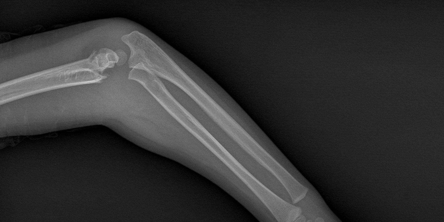 Broken Bones Motorcycle Accident Lawyers Serving Fort Lauderdale