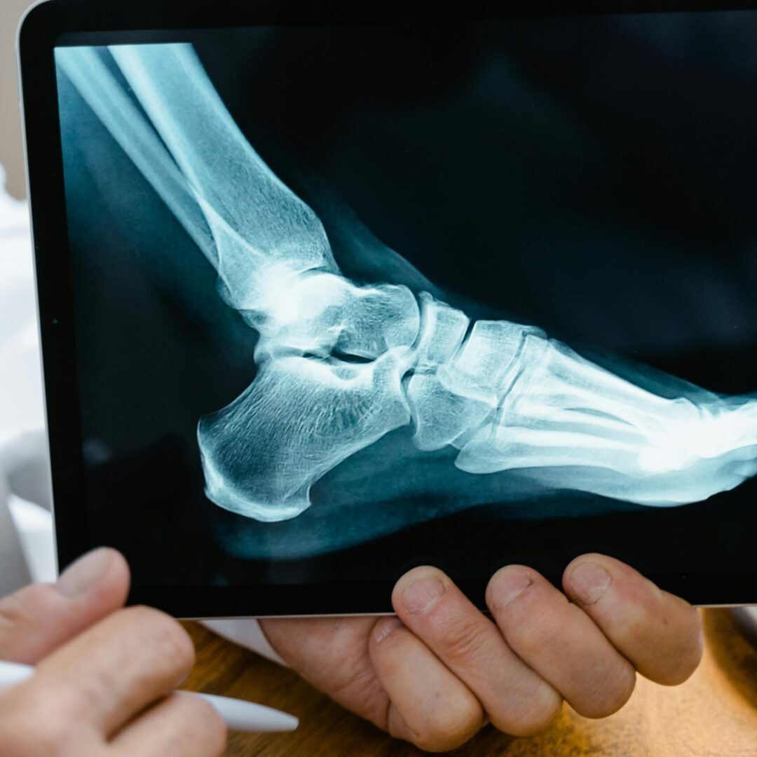 x-ray of a foot